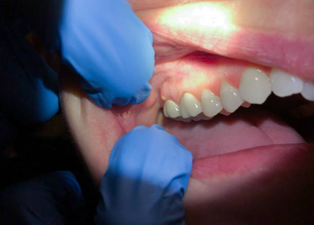 Best Emergency Wisdom Teeth Removal in Peebles, OH